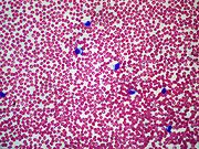 Peripheral blood smear (low power) showing lymphocytosis from a 16-year-old male with pharyngitis and positive monospot test.