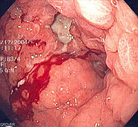 Endoscopic image of linitis plastica, a type of stomach cancer where the entire stomach is invaded, leading to a leather bottle-like appearance with blood coming out of it.