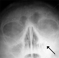 Left-sided maxillar sinusitis (Absence of the air transparency of left maxillar sinus)