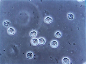 Multiple bacilli (rod-shaped bacteria, here shown as black and bean-shaped) shown between white cells at urinary microscopy. This is called bacteriuria and pyuria, respectively. These changes are indicative of a urinary tract infection, so this sample should be sent for bacterial culture and antibiogram.
