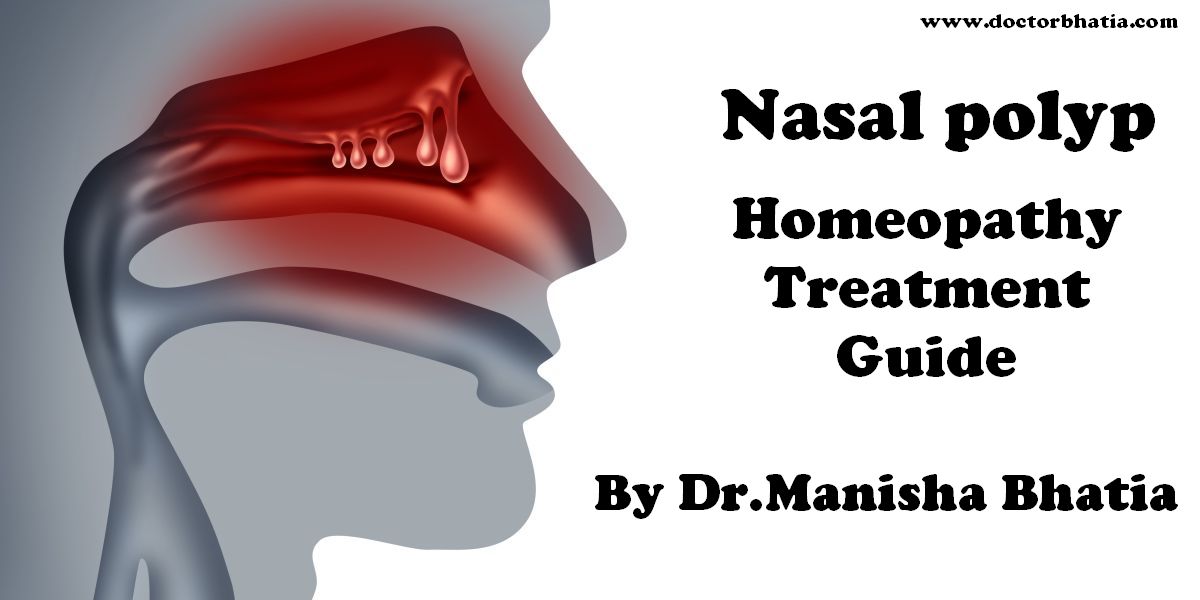 Nasal Polyps Homeopathy Treatment