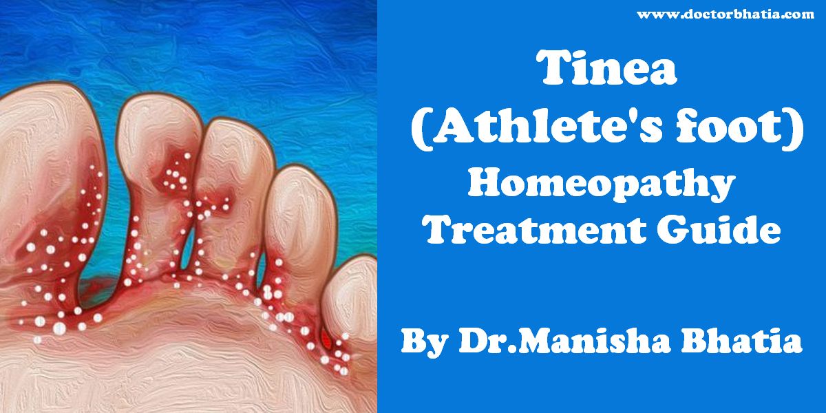 Tinea (Athlete's foot) - Homeopathy Treatment and Homeopathic Remedies -  Doctor Bhatia