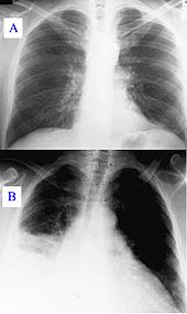 Pneumonia as seen on chest x-ray. A: Normal chest x-ray. B: Abnormal chest x-ray with shadowing from pneumonia in the right lung (white area, left side of image).