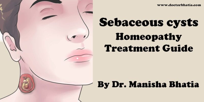 Sebaceous cysts - Doctor Bhatia's Asha Homeopathy