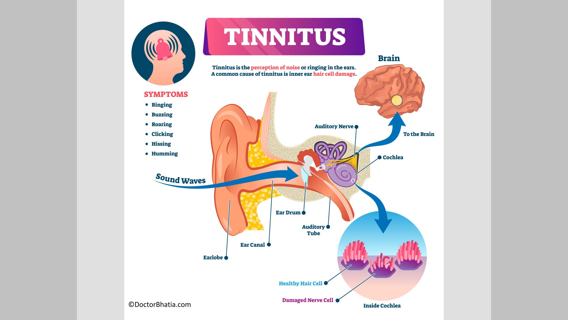 Tinnitus: Why Your Ears Might Be Ringing