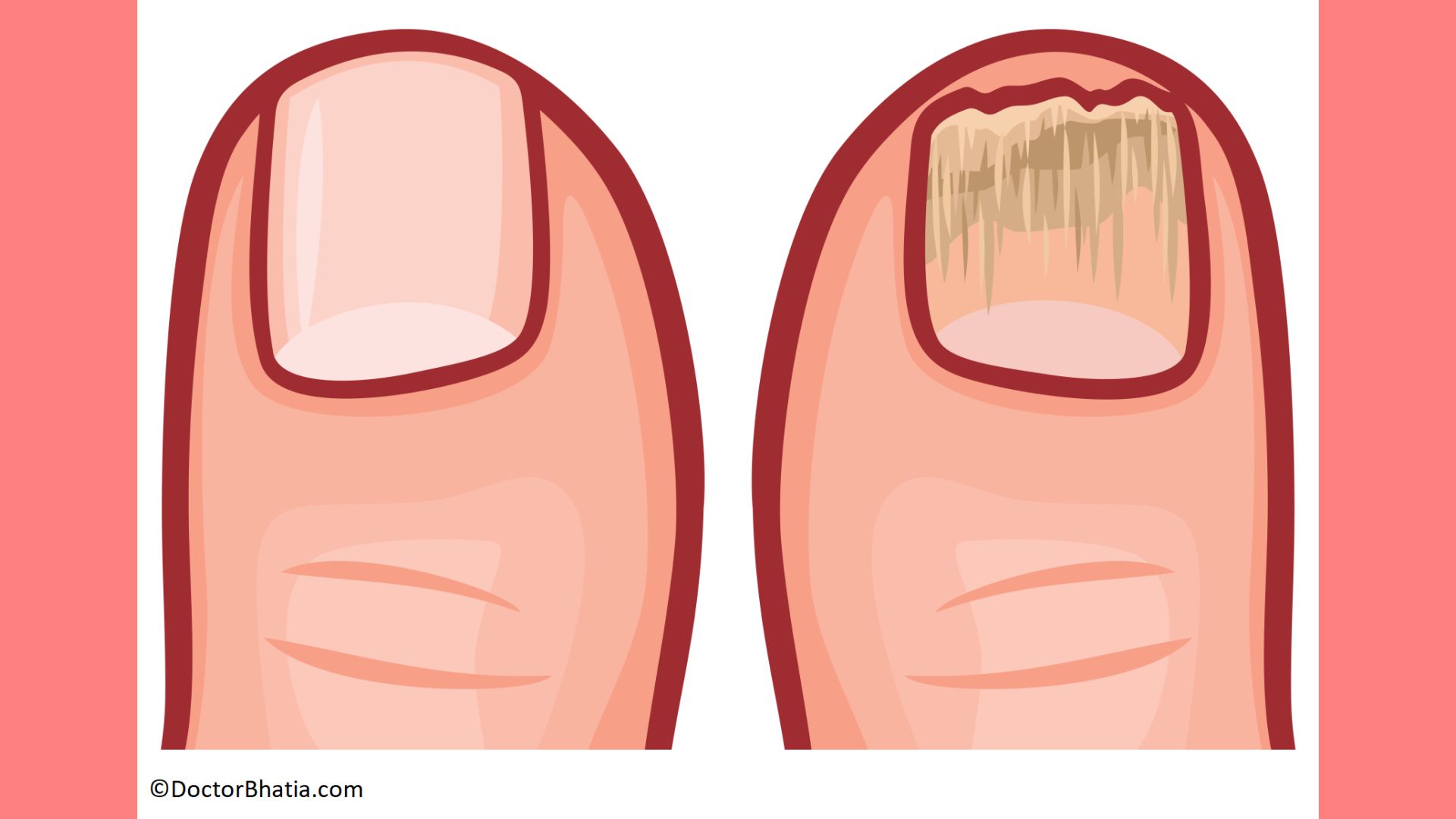 How to get rid of toenail fungus: Home remedies