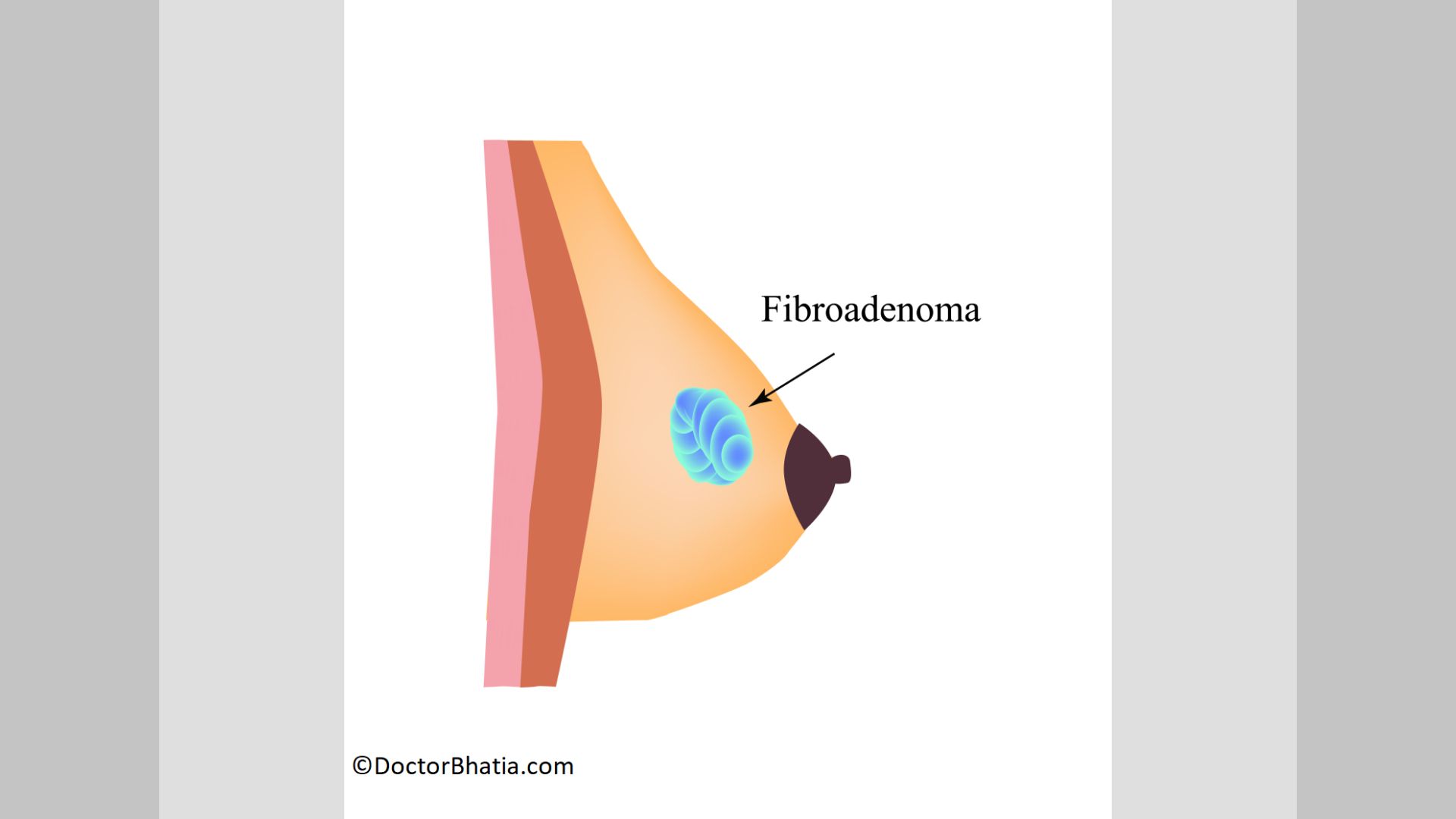 Managing Breast Fibroadenoma and Benign Tumors with Homeopathic Treatment -  Doctor Bhatia